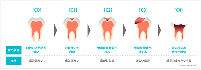 虫歯の進行状況