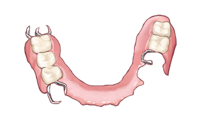 部分義歯