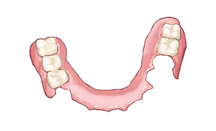 部分義歯