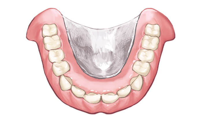 金属床デンチャー
