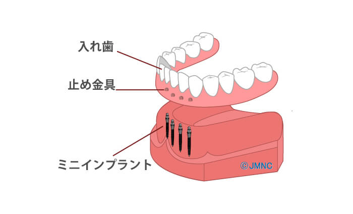 マグネットデンチャー