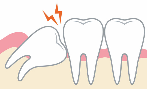 親知らずの痛みの原因